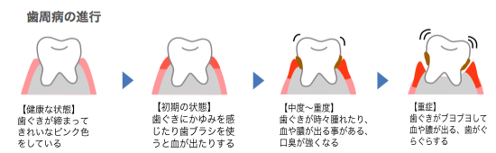 歯周病進行のイラスト